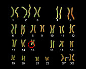 Karyotype of Angelman syndrome, illustration