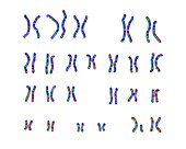 Cri du chat syndrome karyotype, illustration