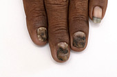 Fungal nail infection