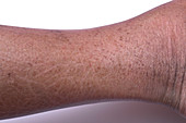 Post inflammatory skin pigmentation
