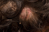 Ringworm of the scalp