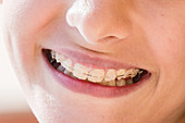 Teenager with fixed braces on her teeth