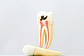 Tooth decay model