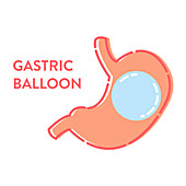 Gastric balloon, illustration