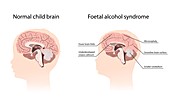 Foetal alcohol syndrome, illustration