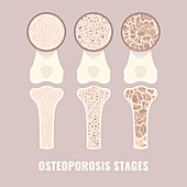 Osteoporosis stages, illustration