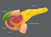 Pancreatic adenocarcinoma, illustration