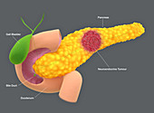 Pancreatic neuroendocrine tumour, illustration