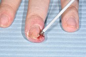 Granulation tissue over fingernail