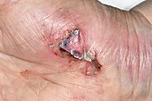 Laceration on palm