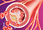 Atherosclerosis of an artery, illustration