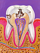 Stages of tooth decay, illustration