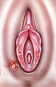 Syphilis chancres on vulva, illustration