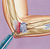 Steroid treatment of teniis elbow, illustration
