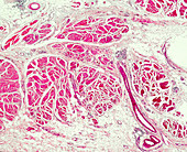 Bladder transitional cell carcinoma, light micrograph