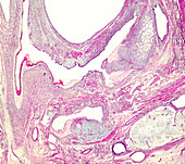 Ovarian mucinous cystadenoma, light micrograph