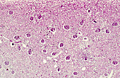 Diffuse capillary glomerulonephritis, light micrograph