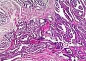 Human glandular cancer, light micrograph