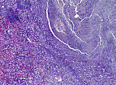 Acute pyelonephritis, light micrograph