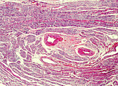 Uterine fibroid, light micrograph