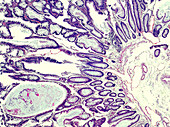 Adenomatous polyp of the large intestine, light micrograph