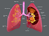 Lung cancer, illustration