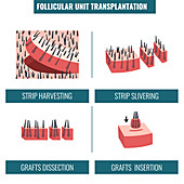 FUT hair transplantation, illustration