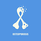 Osteoporosis, conceptual illustration