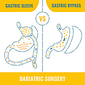 Bariatric surgery, conceptual illustration