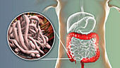 Round worms in human large intestine, illustration