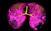 Lungs affected by Covid-19 pneumonia, CT scan