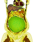 Ovarian cancer, CT scan