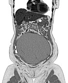 Ovarian cancer, CT scan