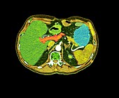 Pancreatic carcinoma, CT scan