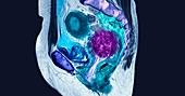 Cervical cancer, MRI scan