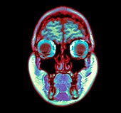 Human head, MRI scan