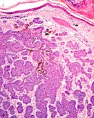 Human basal cell carcinoma, light micrograph