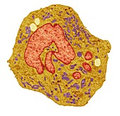 Lymphoma cancer cell, TEM