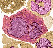 Lymphoma cancer cells, TEM