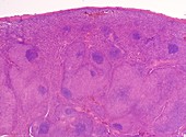Mixed cellularity Hodgkin lymphoma, light micrograph