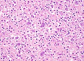 Nodular sclerosis Hodgkin lymphoma, light micrograph
