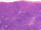 Lymphocyte-rich Hodgkin lymphoma, light micrograph