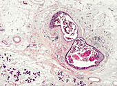 Scirrhous carcinoma of the breast, light micrograph