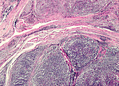 Hodgkin's lymphoma, light micrograph