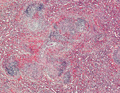 Hodgkin's lymphoma of the spleen, light micrograph