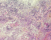 Acute hepatitis A, light micrograph