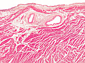 Acute fibrinous pericarditis, light micrograph