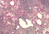 Acute fibrinous pleuritis, light micrograph
