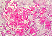 Squamous cell carcinoma of the skin, light micrograph