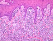 Acral lentiginous melanoma, light micrograph